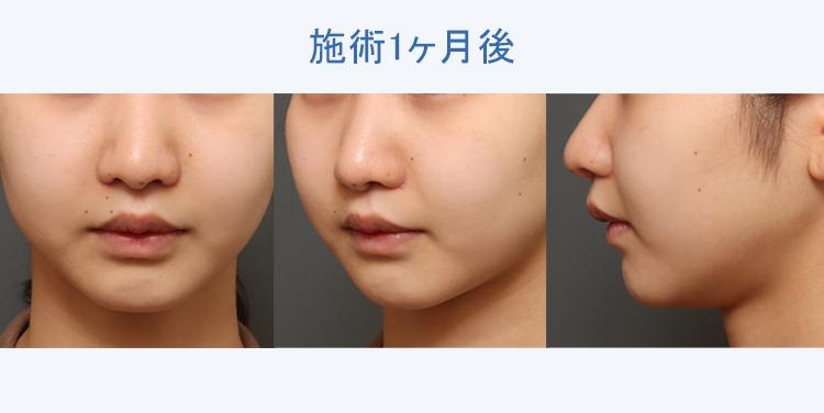 人中短縮+鼻翼縮小+顔の脂肪吸引+バッカルファット除去 施術1ヶ月後の症例写真