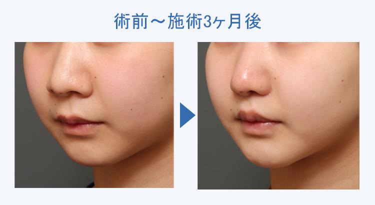 人中短縮+鼻翼縮小+顔の脂肪吸引+バッカルファット除去 術前術後の比較2