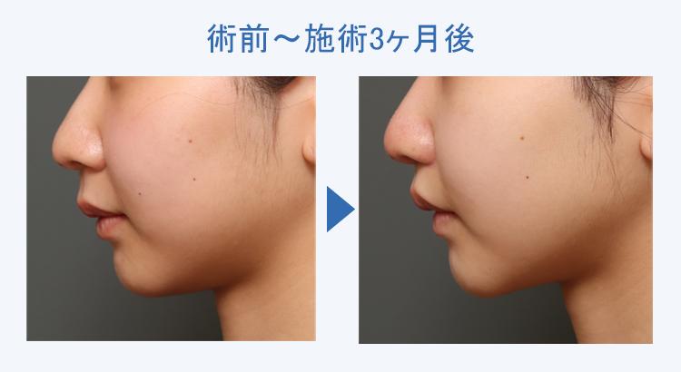 人中短縮+鼻翼縮小+顔の脂肪吸引+バッカルファット除去 術前術後の比較3