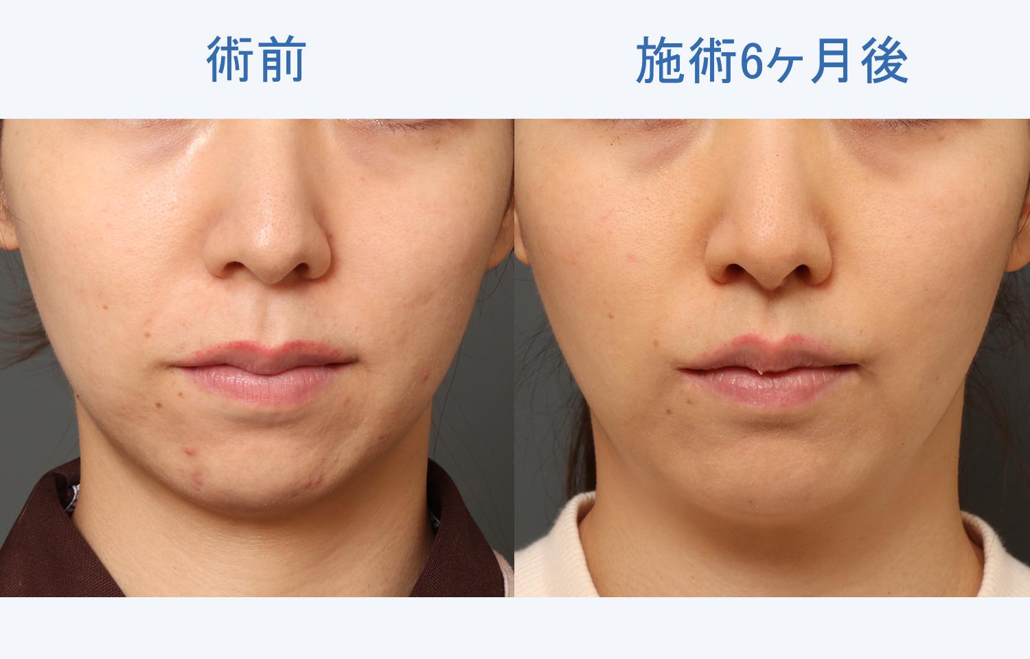 【30代女性ご相談】人中を短くしたい｜人中短縮＋口角挙上施術3ヶ月後