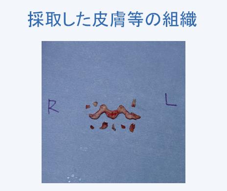 実際に採取した人中、鼻翼の皮膚等の組織