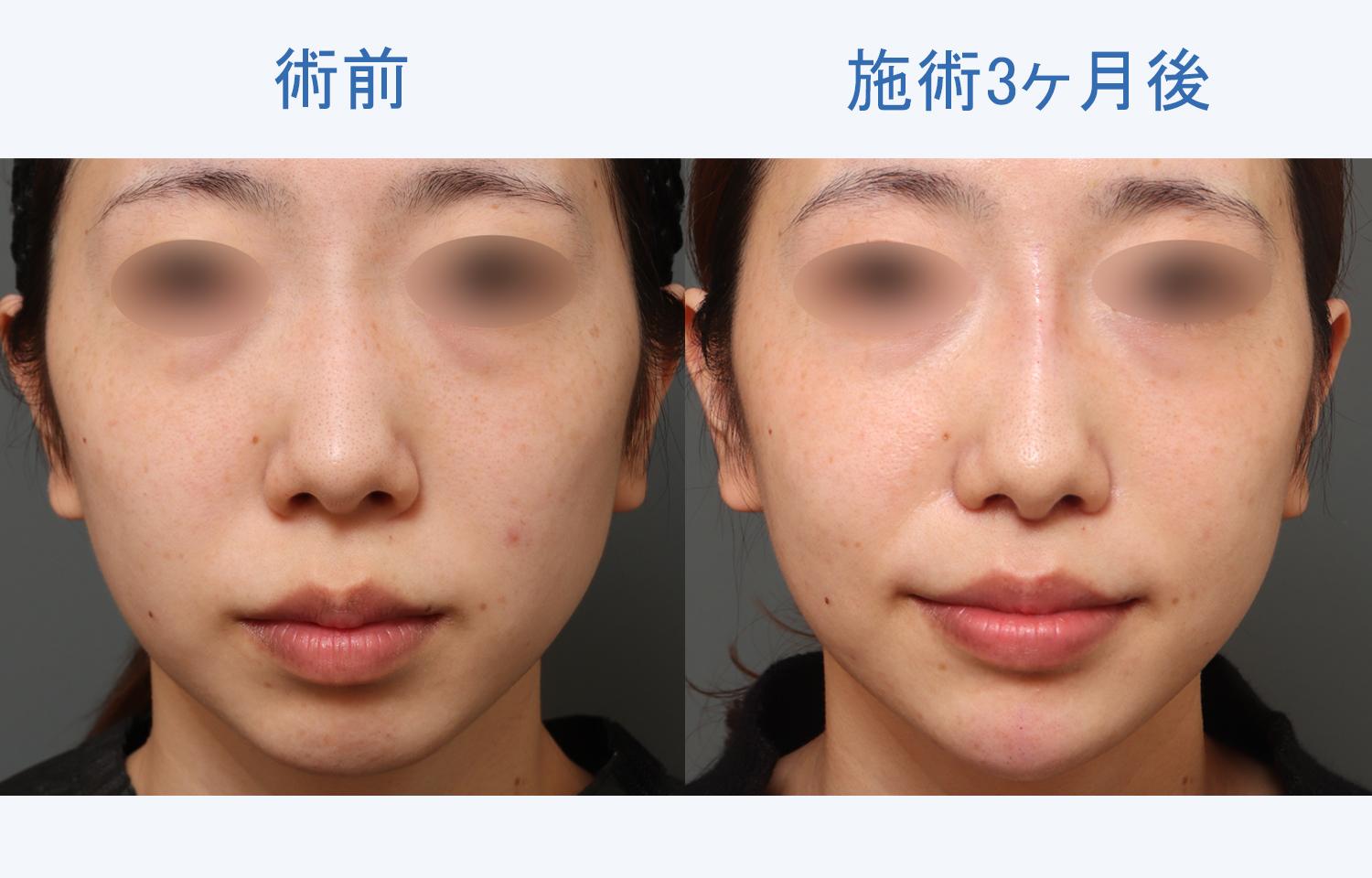 【20代女性ご相談】面長な顔にコンプレックス｜人中短縮+鼻翼縮小+ヒアルロン酸注射施術3ヶ月後
