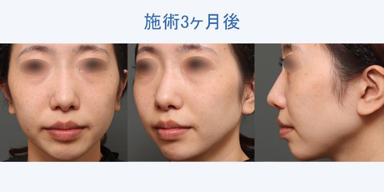 人中短縮+鼻翼縮小 施術3ヶ月後の症例写真