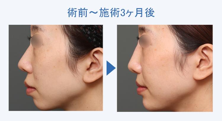 人中短縮+鼻翼縮小+ヒアルロン酸注射（アゴ形成・鼻形成） 術前術後の比較3