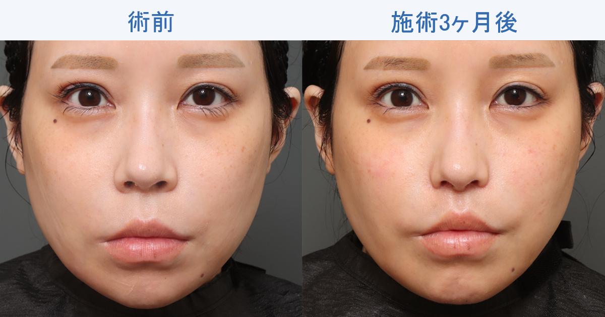 マスクを外しても好印象に！人中短縮＋鼻翼縮小の3ヶ月後の仕上がりは