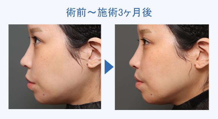 人中短縮+鼻翼縮小 術前術後の比較3