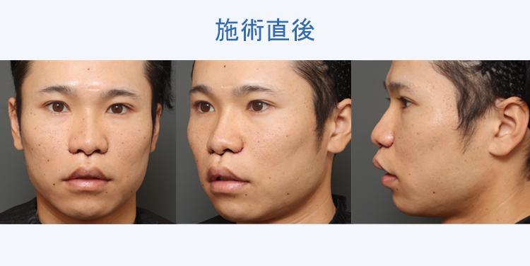 人中短縮+鼻翼縮小 施術直後の症例写真