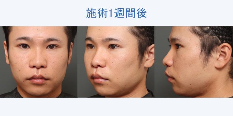 人中短縮+鼻翼縮小 施術1週間後の症例写真
