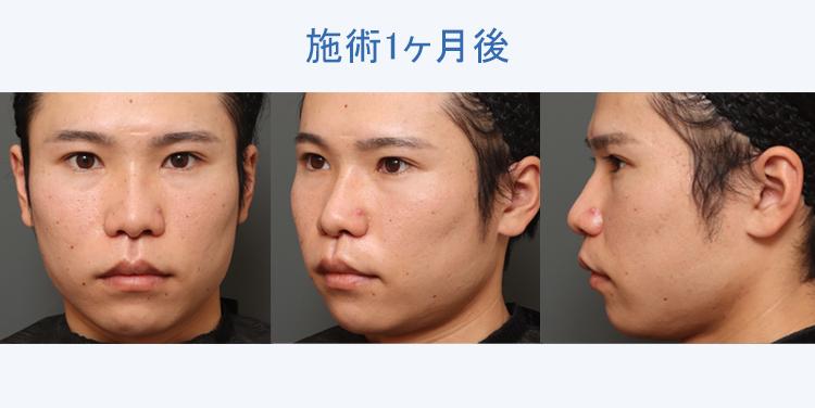 人中短縮+鼻翼縮小 施術1ヶ月後の症例写真