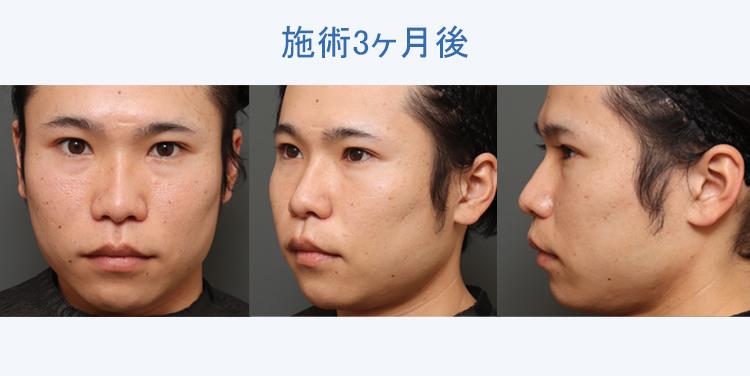 人中短縮+鼻翼縮小 施術3ヶ月後の症例写真