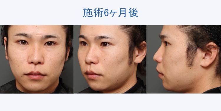 人中短縮+鼻翼縮小 施術6ヶ月後の症例写真
