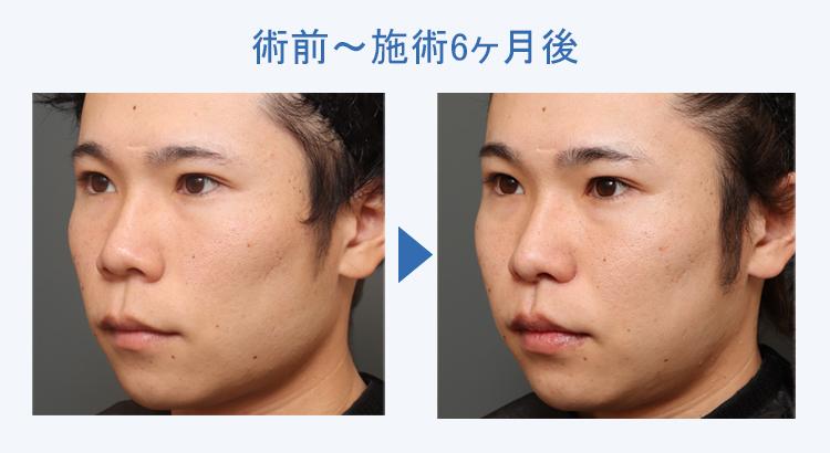 人中短縮+鼻翼縮小 術前術後の比較2