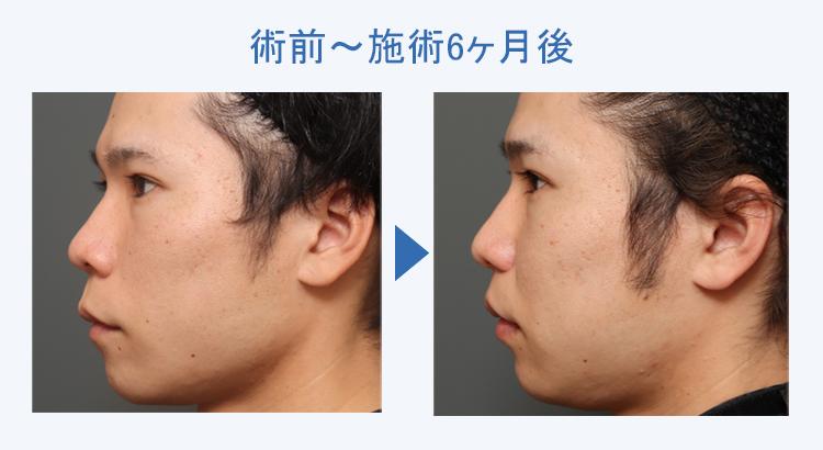 人中短縮+鼻翼縮小 術前術後の比較3