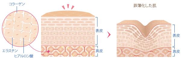 菲薄化