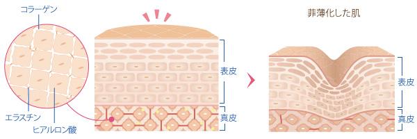 菲薄化