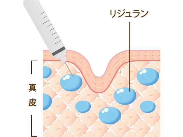 リジュランHBの注入方法