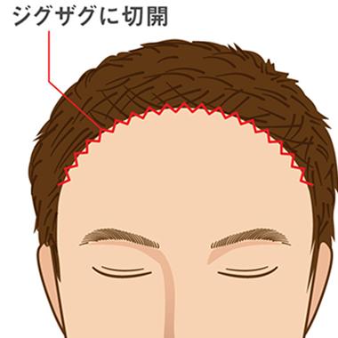 生え際のヘアラインに沿って切開