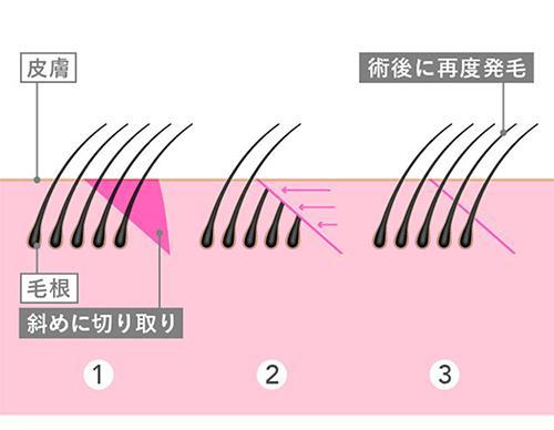 毛包斜切断法