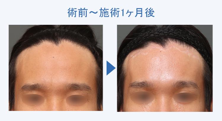 生え際前進術 術前術後の比較1