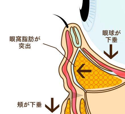 眼窩脂肪の突出