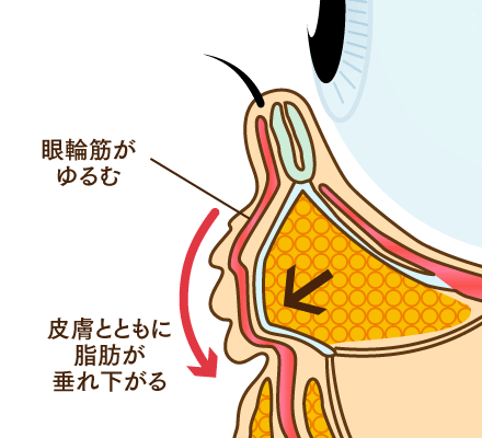 眼輪筋のゆるみ