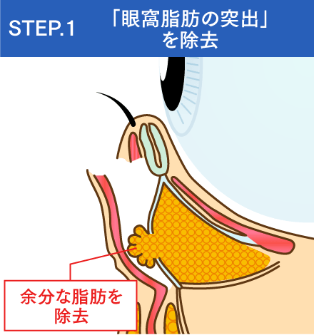 「眼窩脂肪の突出」を除去