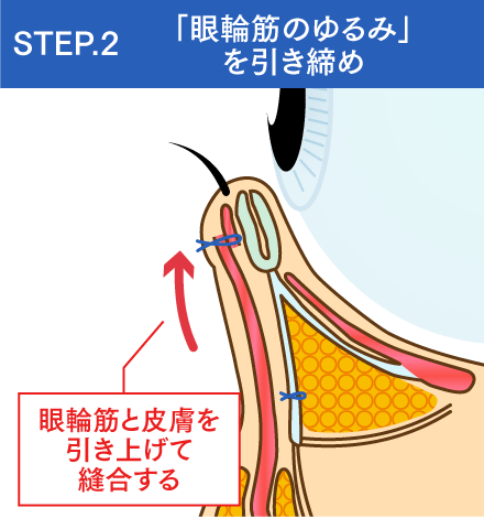 「眼輪筋のゆるみ」を引き締め