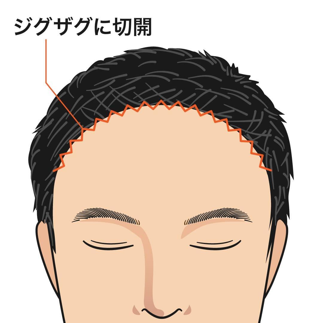 生え際のヘアラインに沿って切開