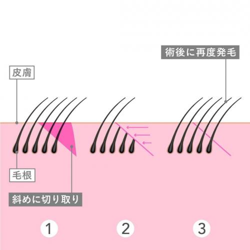 生え際前進術、当院のこだわり