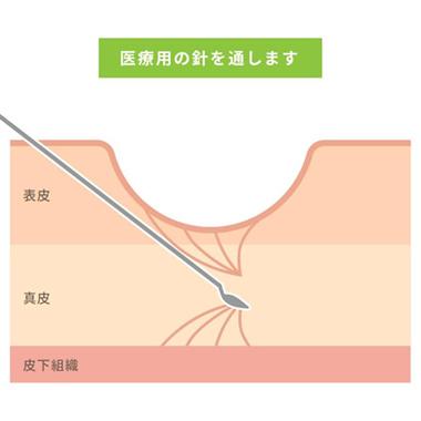 ニキビ・ニキビ跡にお悩みなら：サブシジョン（ニキビ跡治療）