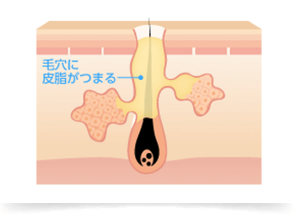 皮脂の過剰分泌による角栓の詰まり