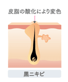 黒ニキビ発生