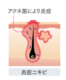 赤ニキビ発生