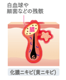 黃ニキビ発生