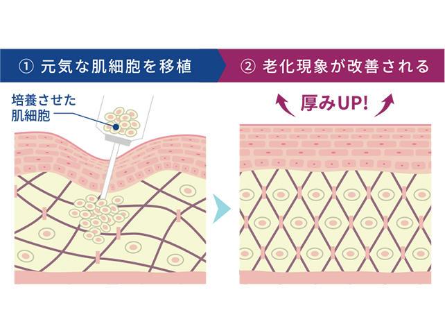 小ジワに効果的な治療3：真皮線維芽細胞療法