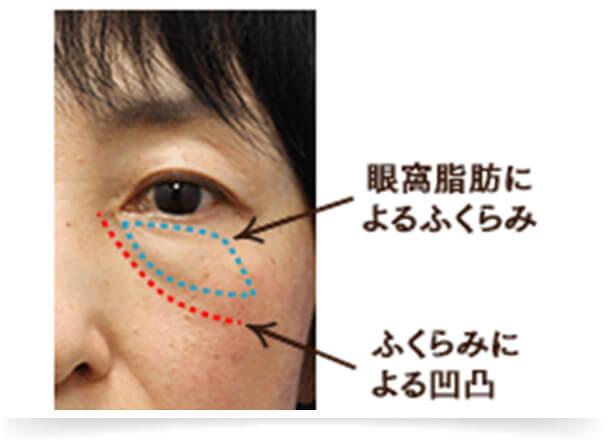 黒クマの原因1：眼窩脂肪の突出