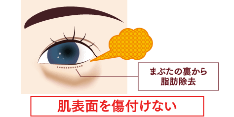 「眼窩脂肪の突出」を除去