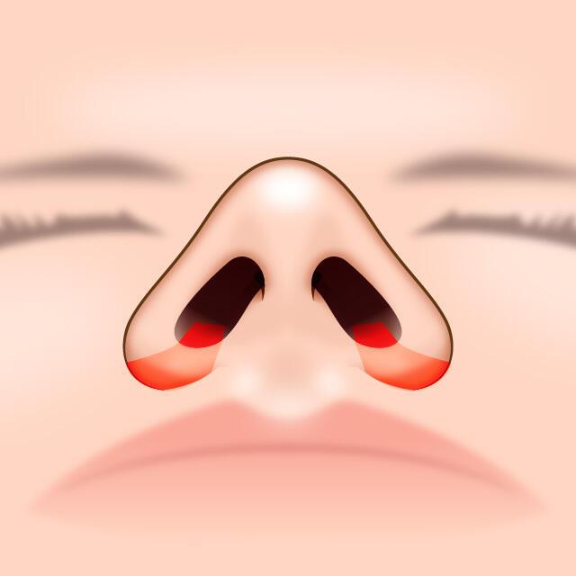 術式3：外側法＋内側法