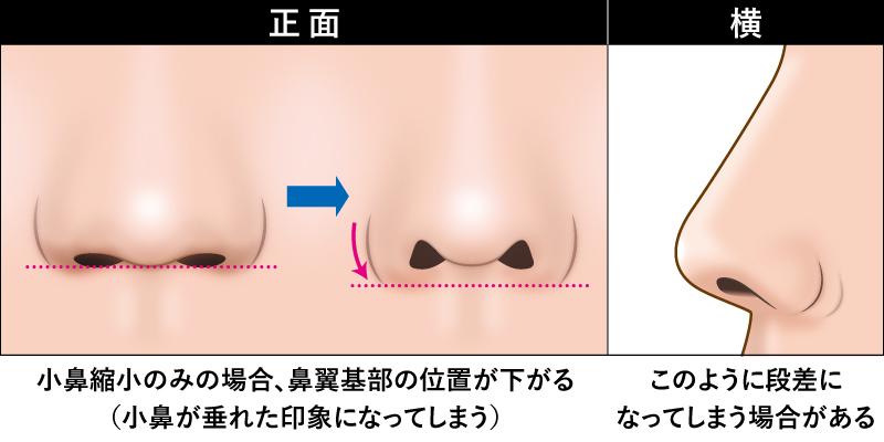 小鼻の付け根が下垂するイメージ、段差になってしまうイメージ