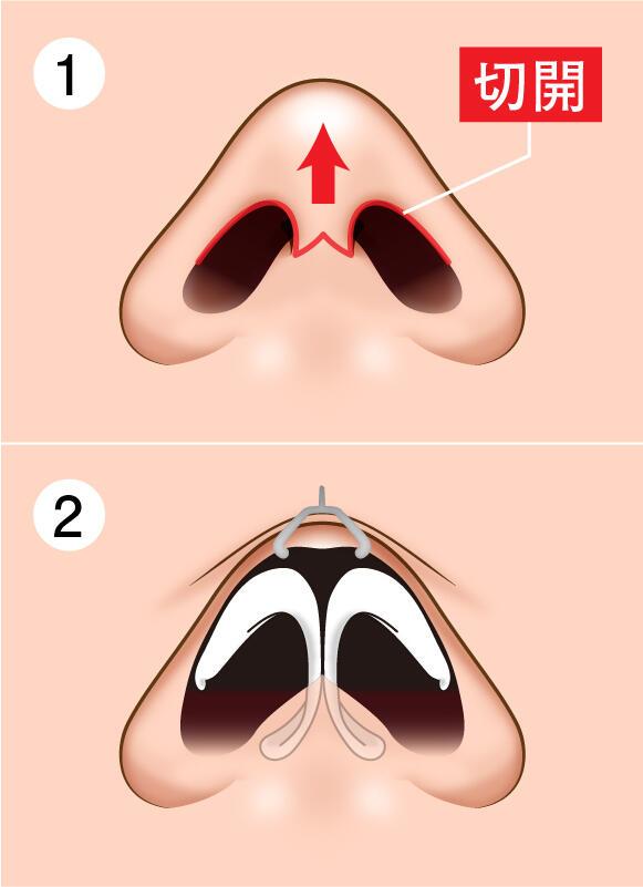 column_nose05_contents15.jpg