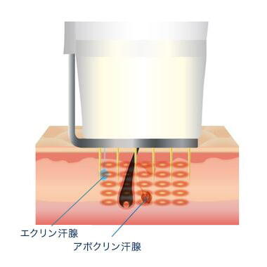 ビューホットでワキガ 多汗症の治療をしよう メリットや注意点を紹介 公式 オザキクリニック ビューホットでワキガ 多汗症の治療をしよう メリットや注意点を紹介 公式 オザキクリニック