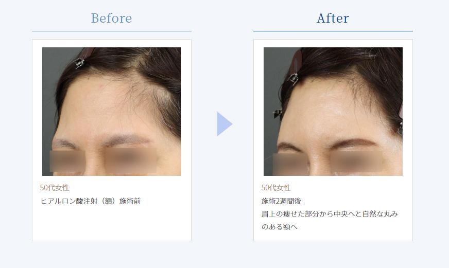おでこのヒアルロン酸注射の症例写真1