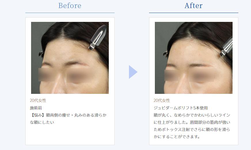 おでこのヒアルロン酸注射の症例写真2