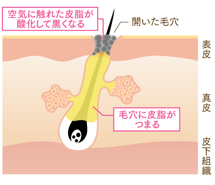 毛穴が開いたままである