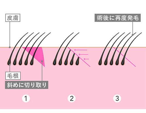 「毛包斜切断法」