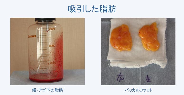 実際に吸引した脂肪