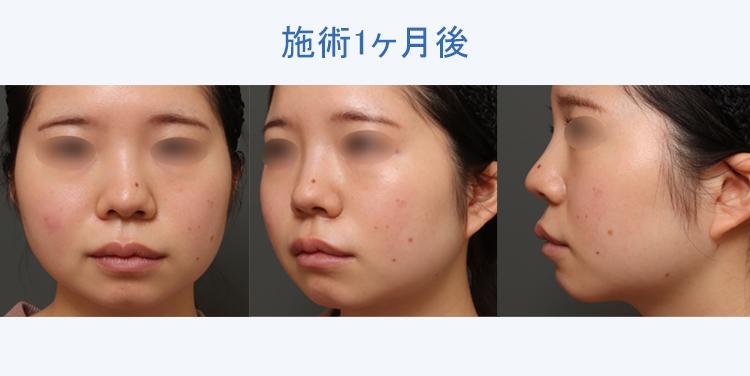顔の脂肪吸引 施術1ヶ月後の症例写真