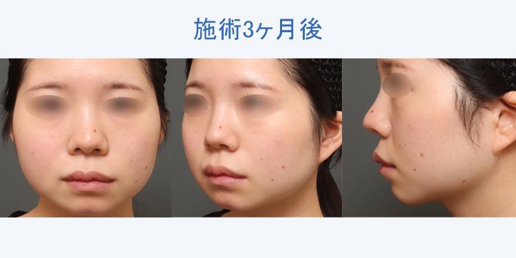 顔の脂肪吸引 施術3ヶ月後の症例写真