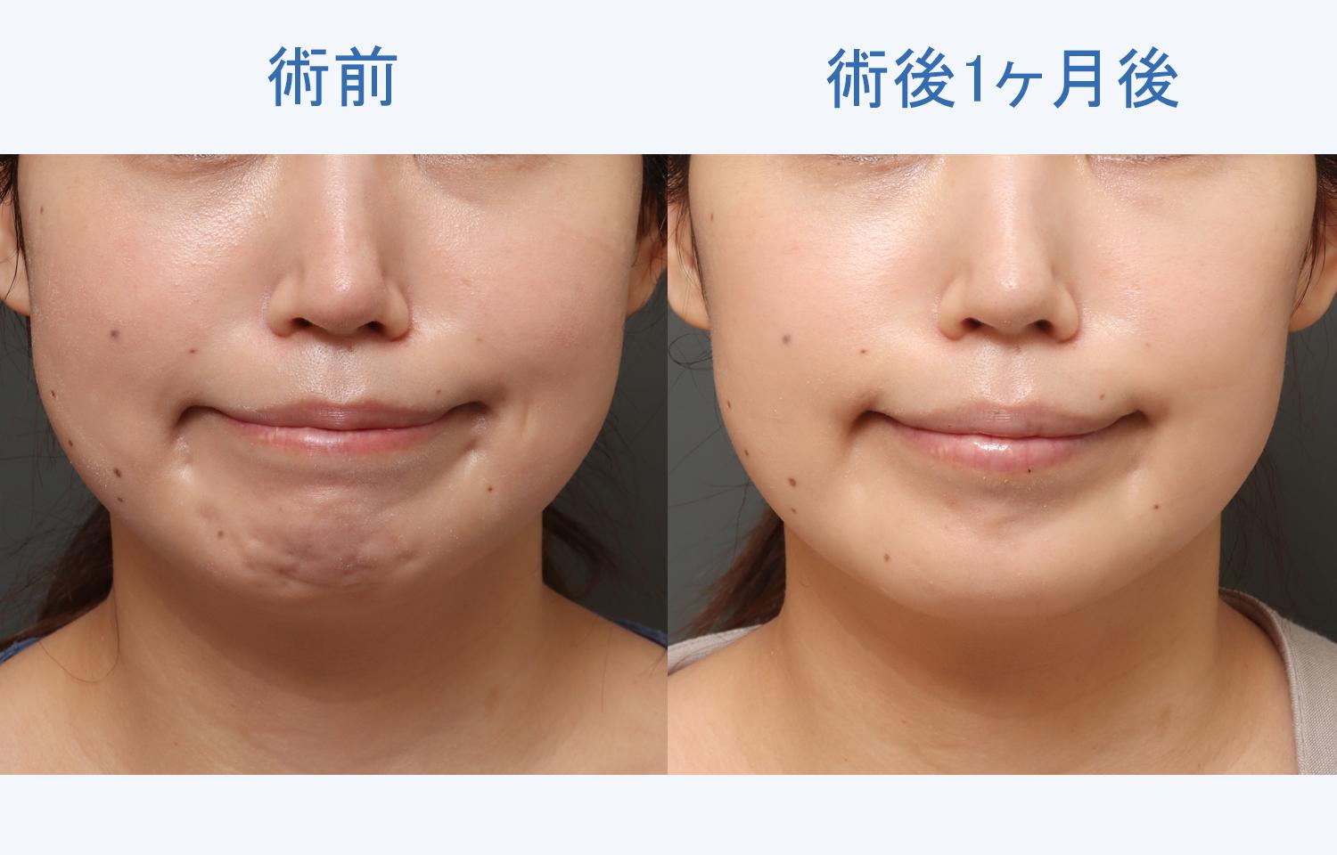 ボトックス治療の潜在的な副作用にはどのようなものがありますか?