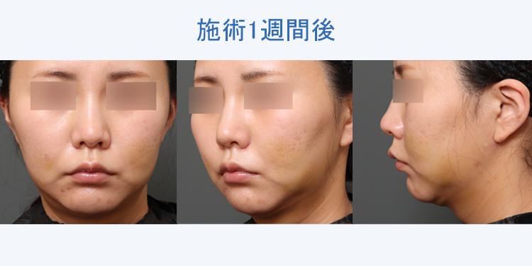 フェイスタイト+顔の脂肪吸引 施術1週間後の症例写真